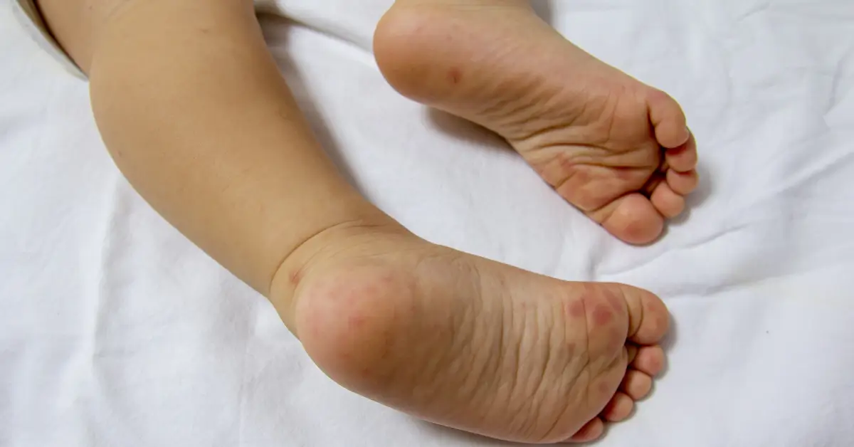 Red spots and rash on the soles of a child's feet during an HFMD outbreak.
