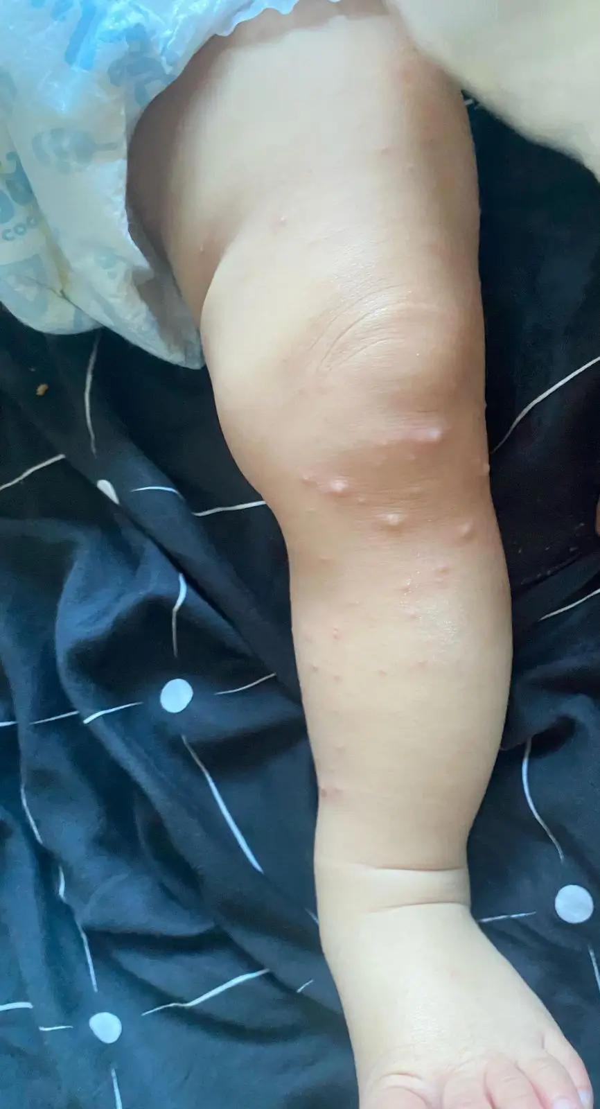 Visible blisters and raised bumps on a baby’s leg during a more severe stage of HFMD.